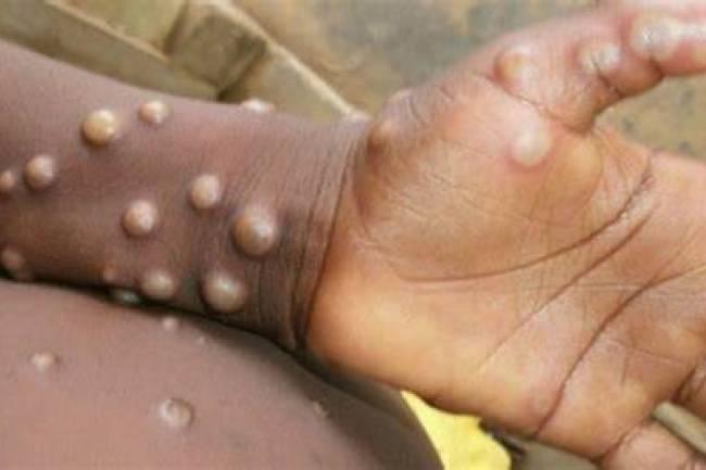 Médica cordobesa que atiende casos de "viruela del mono" en Inglaterra