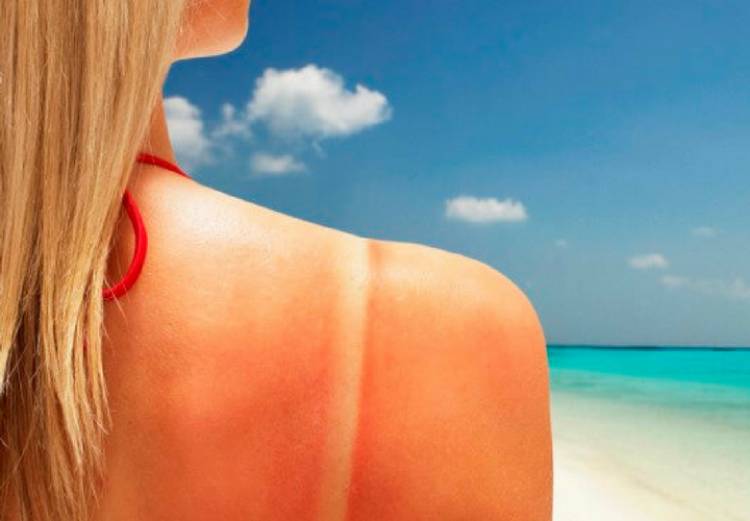 ¡Qué flechazo!: 7 remedios caseros que alivian las quemaduras de sol