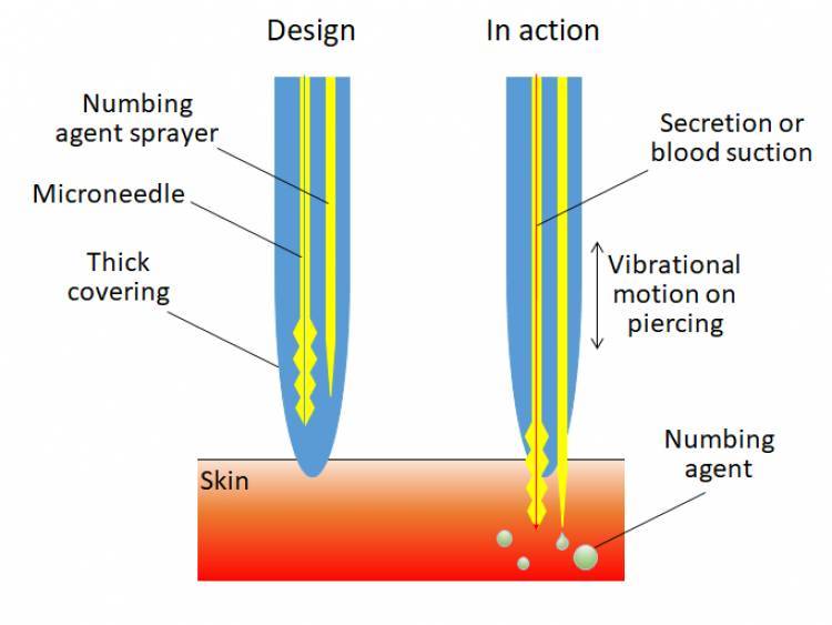 Agujas indoloras inspiradas en la picadura del Mosquito