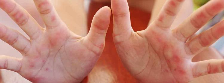 ¿Qué es la Epidermólisis Bullosa?