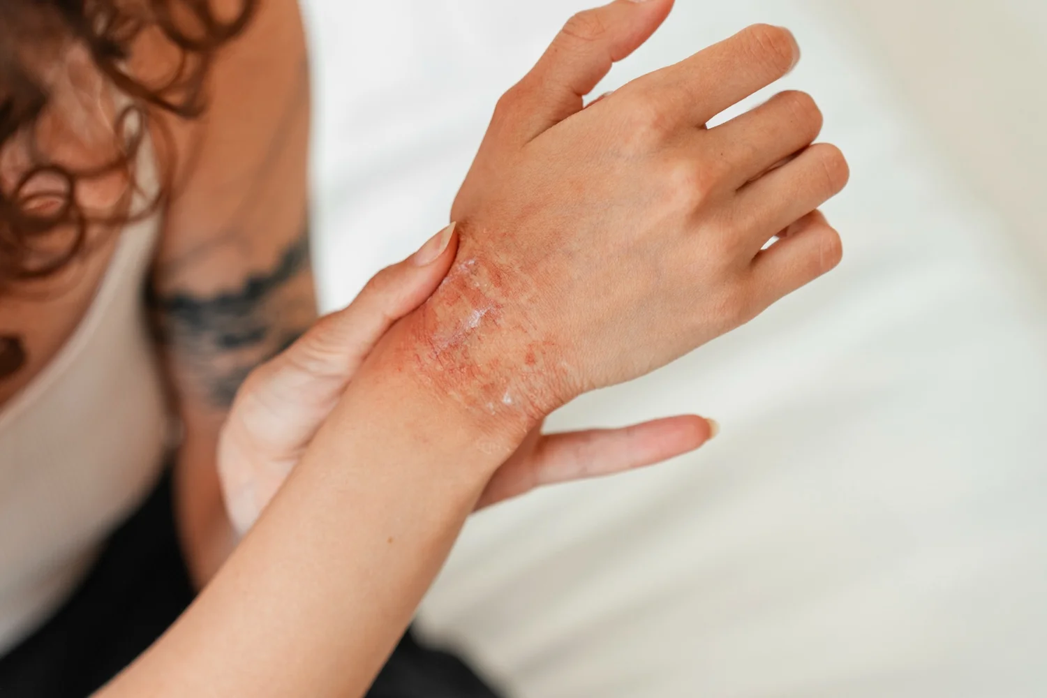 Famoso laboratorio dermatológico revela datos preocupantes sobre el eczema atópico en adultos